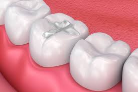 Tooth-Colored Fillings